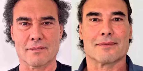 Eduardo Yáñez estrena nueva cara tras someterse a rejuvenecimiento facial