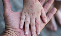No hay casos de sarampión en San Luis Potosí: Secretaría de Salud