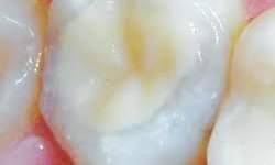 Tratamiento Restaurador Atraumático nueva alternativa bucodental: SSA