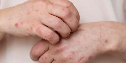 Alerta NL por riesgo de contagios de sarampión ante temporada vacacional