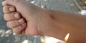 Llama Salud a prevenir y atender las autolesiones en adolescentes