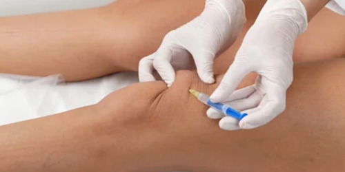 No es cierto que estén robando líquido de rodilla