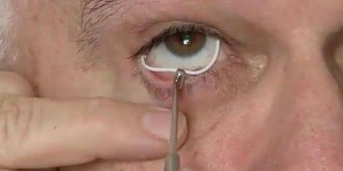 Glaucoma segunda causa de ceguera en mayores de 40 años, en el mundo