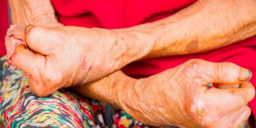 Se registraron varios casos de lepra en Yucatán y Quintana Roo