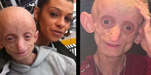¿Como Benjamin Button? Muere joven de 18 años tras padecer enfermedad que envejeció su cuerpo