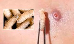 En Tamasopo seda el primer caso de gusano barrenador en humanos