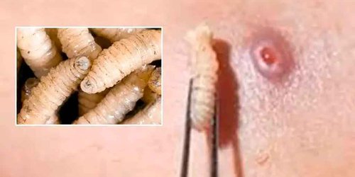 En Tamasopo seda el primer caso de gusano barrenador en humanos